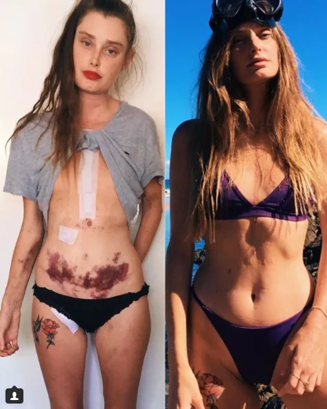Model struck by mystery virus in Bali which led to a HEART TRANSPLANT opens up about her scars