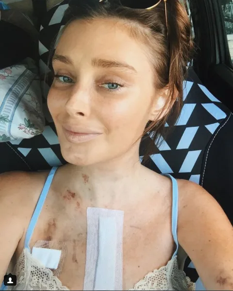 Model struck by mystery virus in Bali which led to a HEART TRANSPLANT opens up about her scars