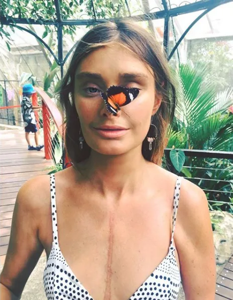 Model struck by mystery virus in Bali which led to a HEART TRANSPLANT opens up about her scars
