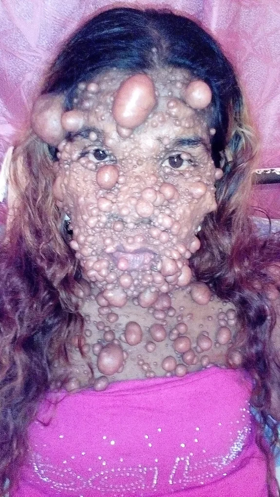 Pregnancy sparks extreme ‘bubble wrap’ skin condition in mum-of-two