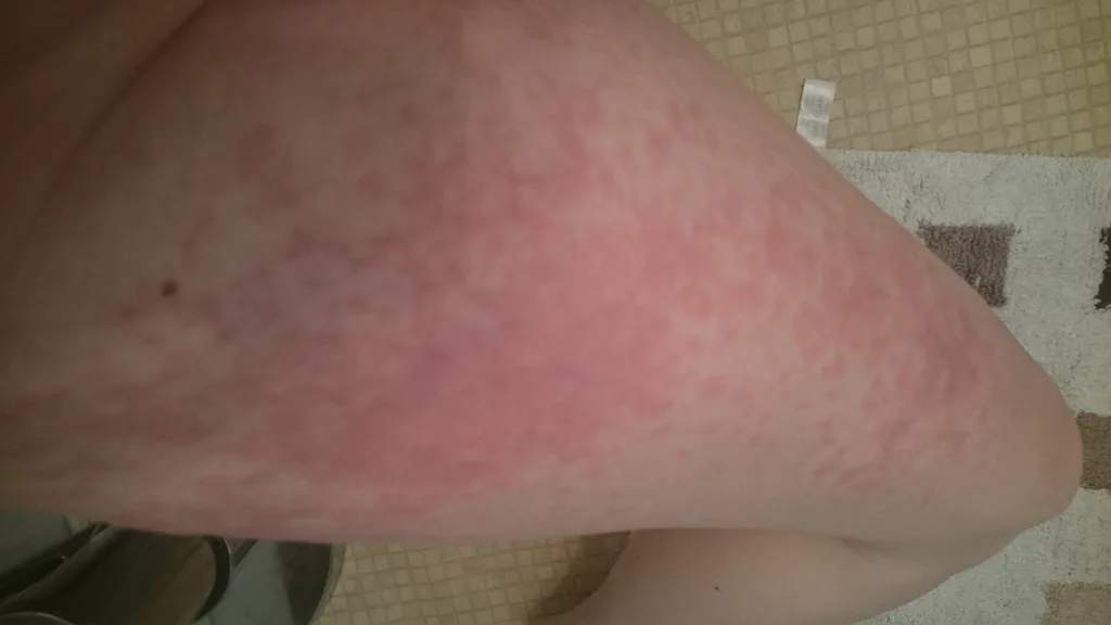 I was ALLERGIC to my baby