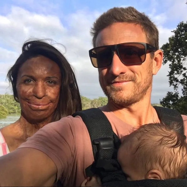 Turia Pitt: Why I chose to have a nose reconstruction