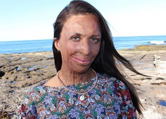 Turia Pitt: Why I chose to have a nose reconstruction