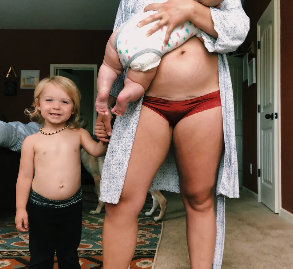 Why this mum-of-two is baring her C-section scar