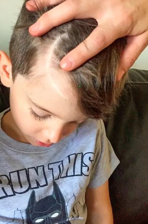 Madden's scar today