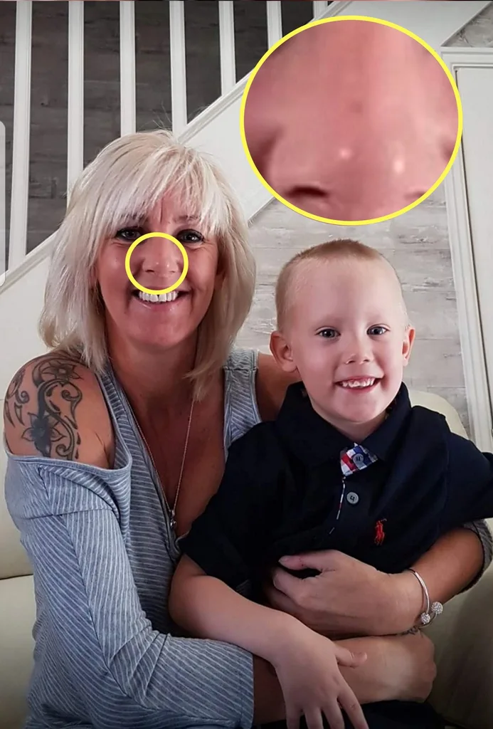 my clogged pore was skin cancer