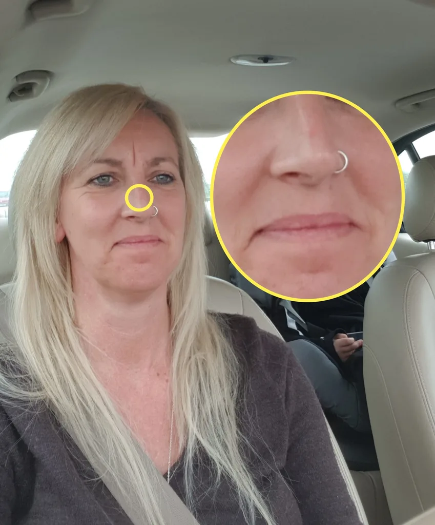 my clogged pore was skin cancer