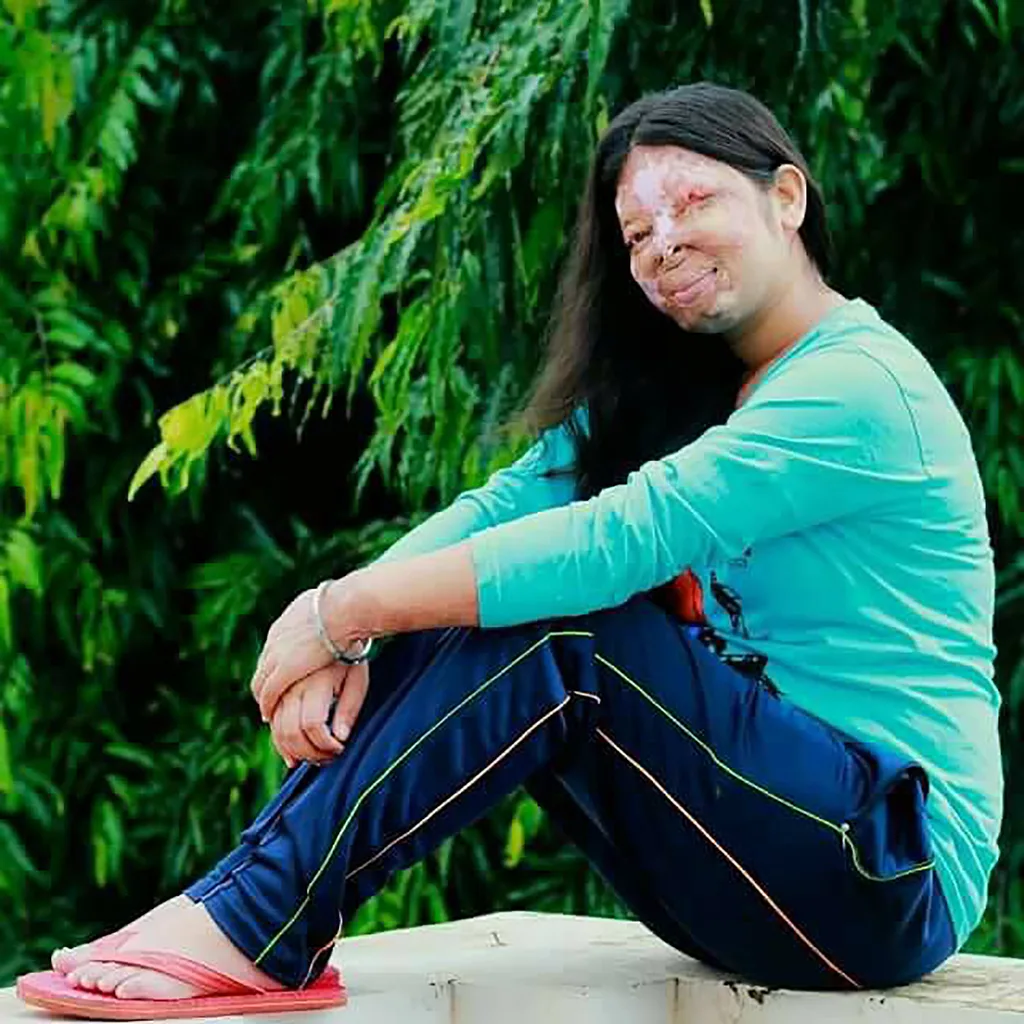 Acid attack survivor talks about moment she was scarred for life