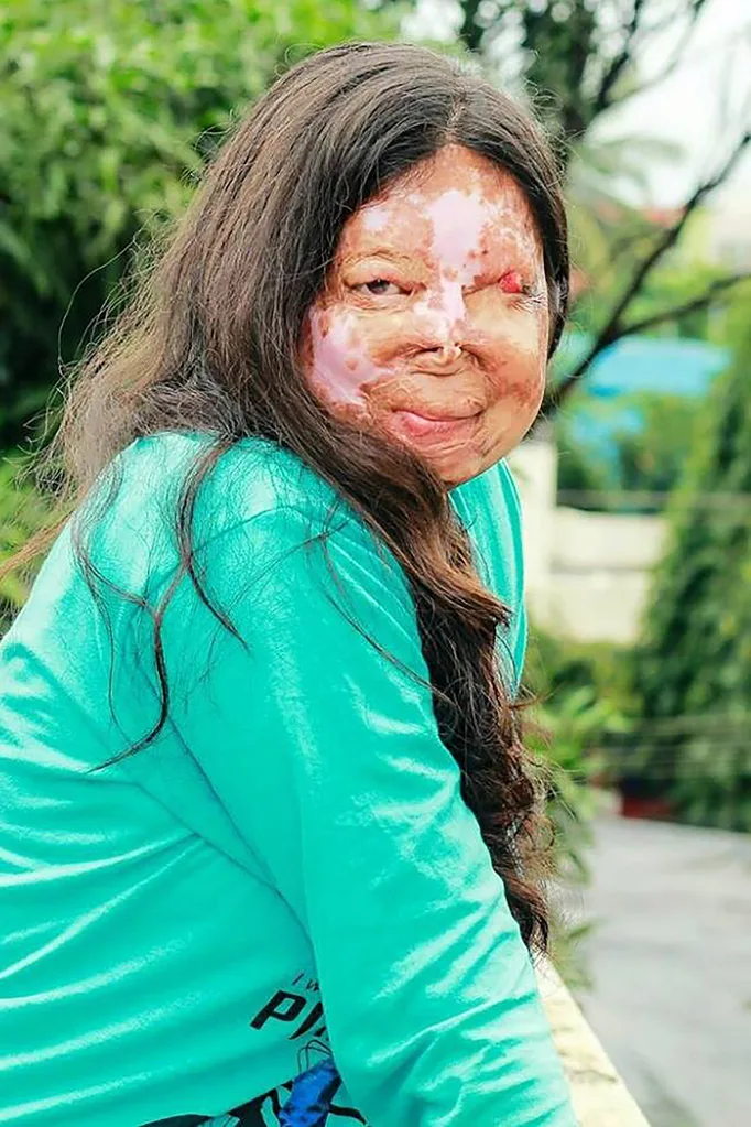 Acid attack survivor talks about moment she was scarred for life
