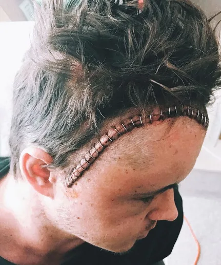 Johnny Ruffo girlfriend Tahnee Sims shares instagram post on brain tumour battle