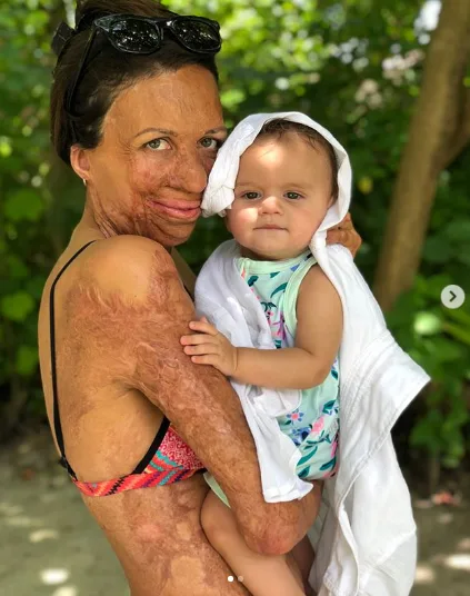 Turia Pitt: Don’t call me a burns victim