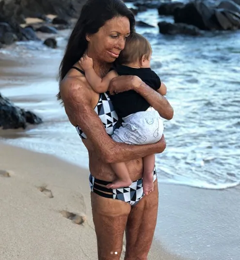 Turia Pitt: Don’t call me a burns victim