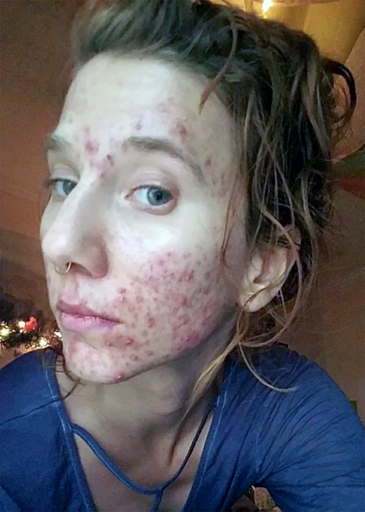 Urine therapy what is it and can it clear acne