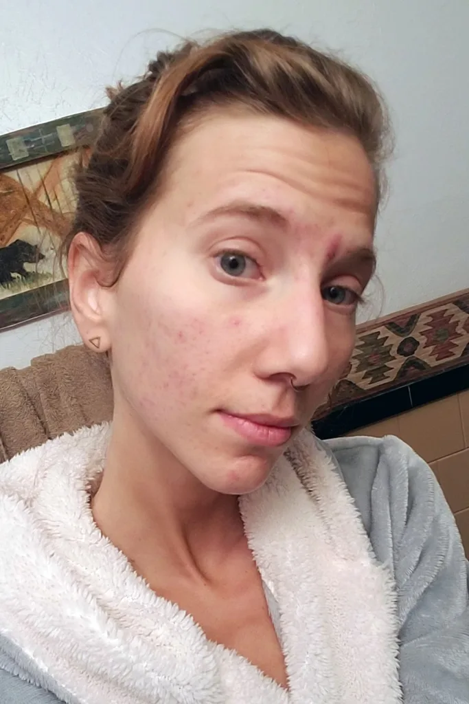 Urine therapy what is it and can it clear acne