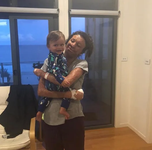 Turia Pitt hospitalised