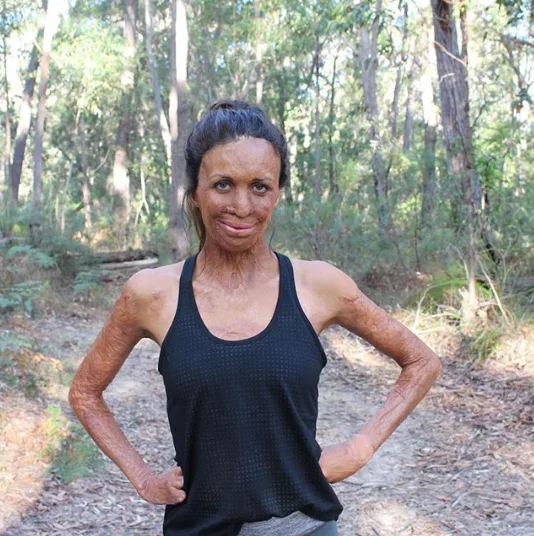 Turia Pitt hospitalised