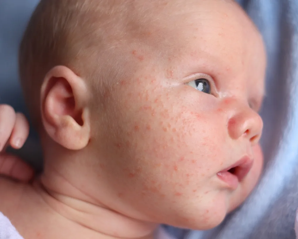 baby acne