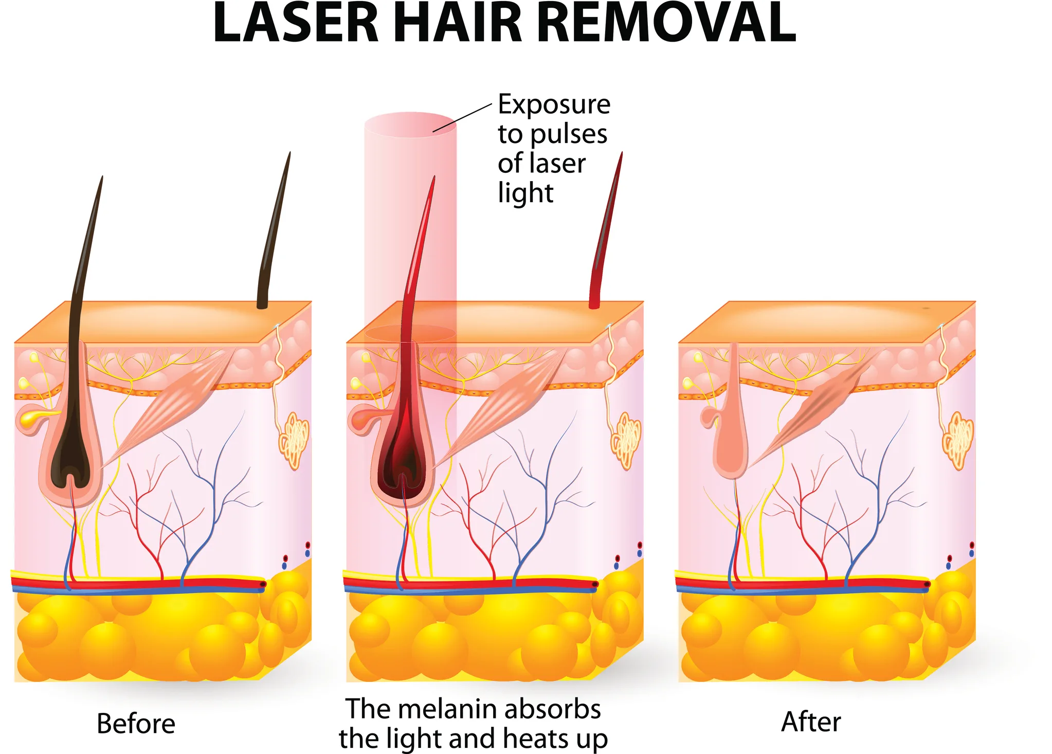 Laser Hair Removal