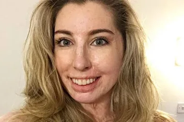 Burns survivor Catrin Pugh lands beauty campaign