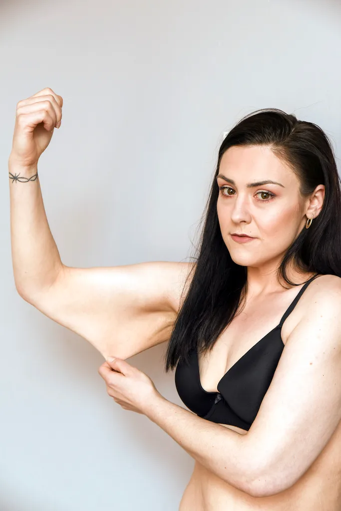Excess skin removal weight loss crowdfunding