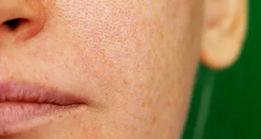 Get Rid Of Blackheads Once And For All