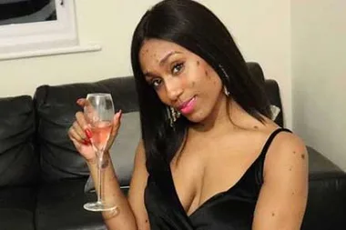 Mum bullied for skin condition lands modelling contract