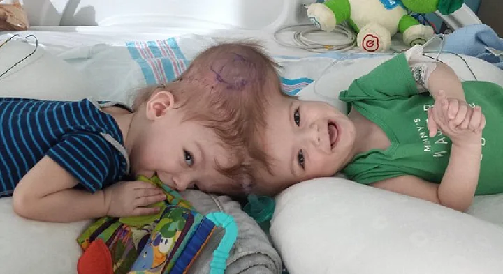 Conjoined twin babies lying on a bed, one smiling and the other resting on a colorful pillow.