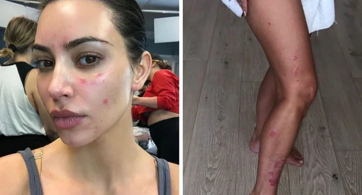 kim kardashian psoriasis
