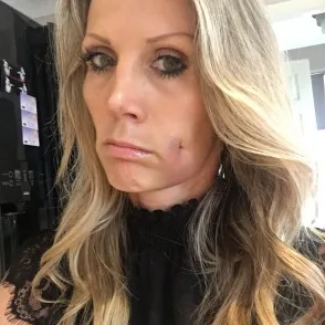 After the surgery