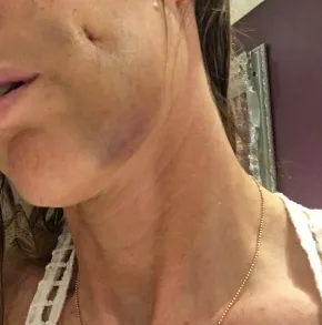 The mum experienced bruising for several weeks after the procedure.