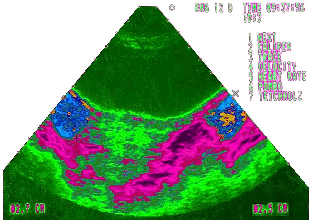 An ultrasound of PCOS-affected ovaries.