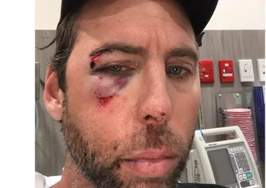 A bearded man with injuries on his face, including bruises and cuts, in a hospital setting.