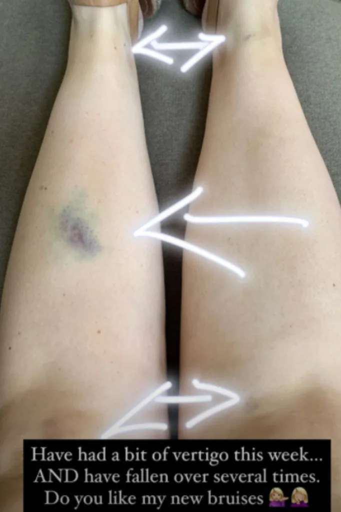 Chezzi Denyer bruises