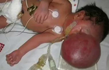 Baby born with his brain outside his skull has incredible transformation!