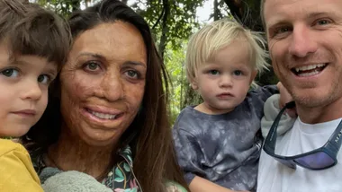 A smiling family outdoors; a woman with burn scars, two children, and a man holding one of the children.