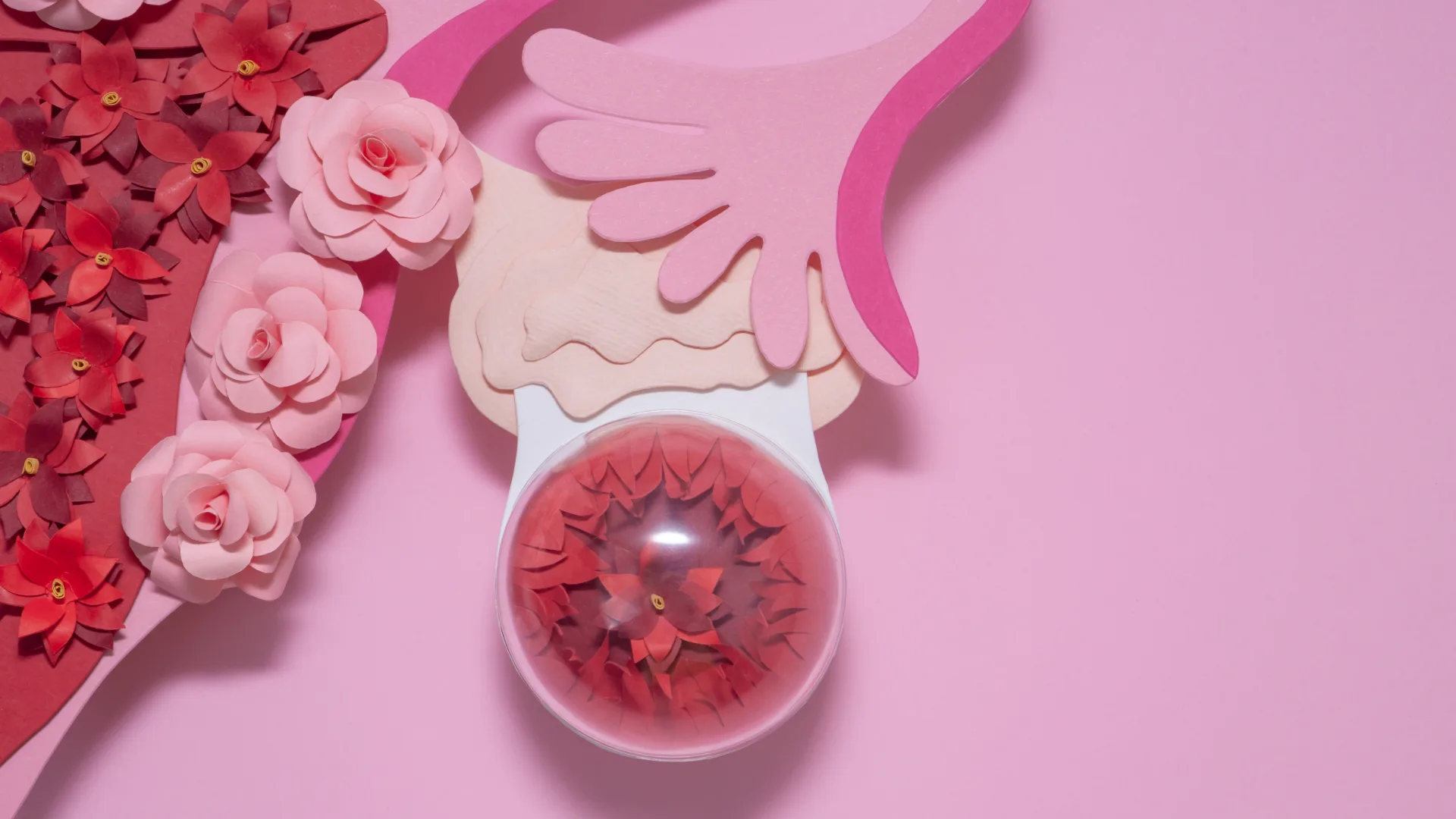 Artistic rendering of endometriosis