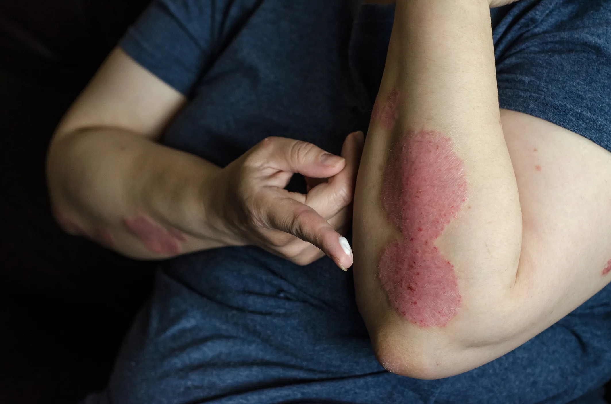 Woman applying cream to psoriasis