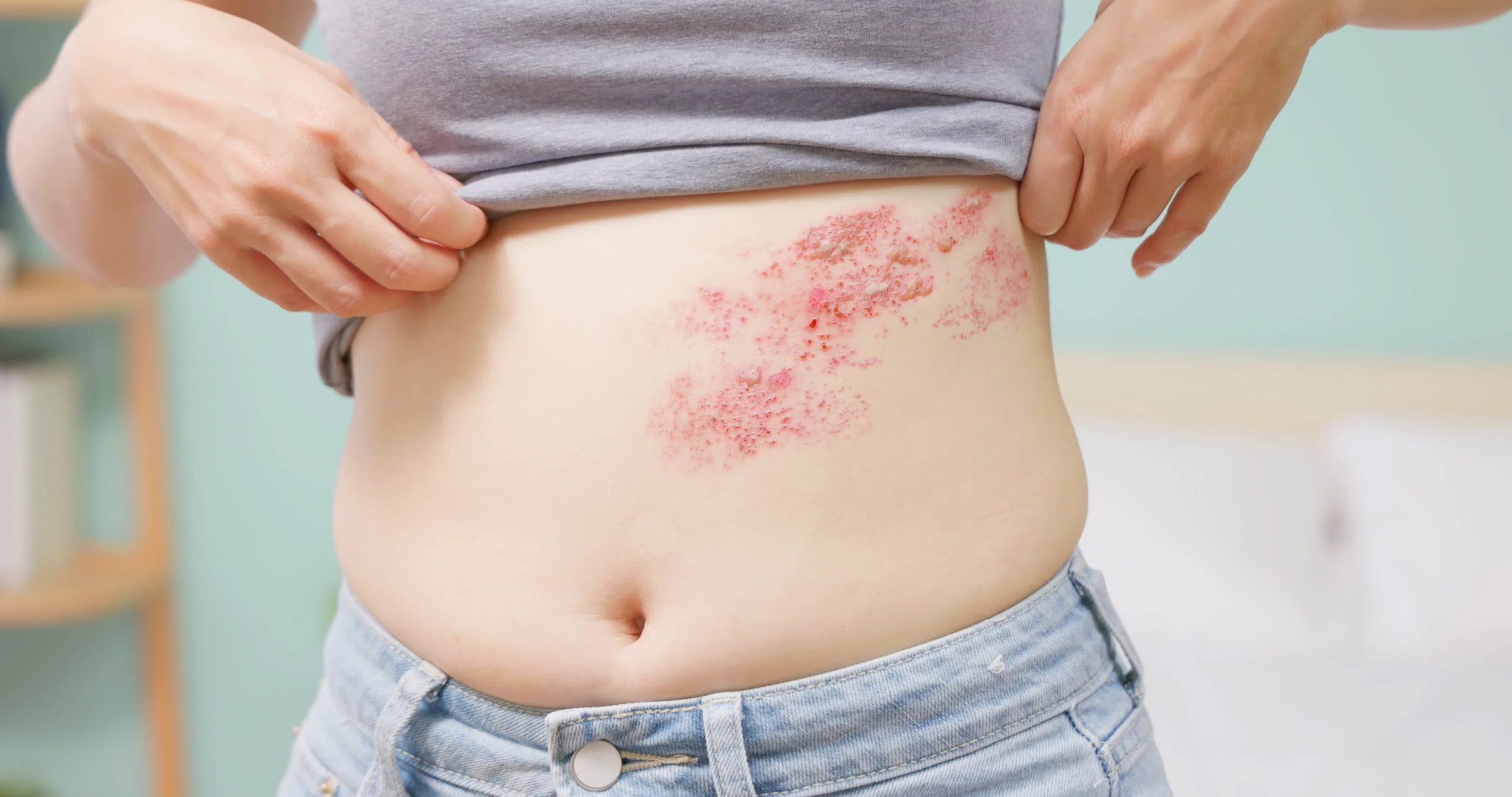 Woman with shingles rash on torso