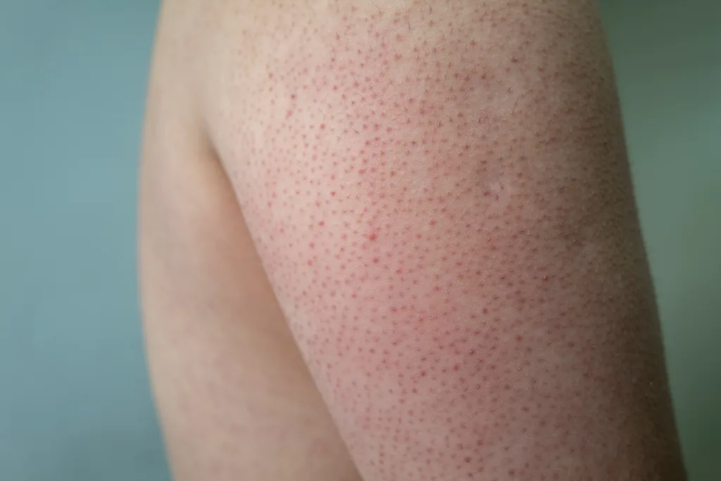 A person with keratoris pilaris on their arm.