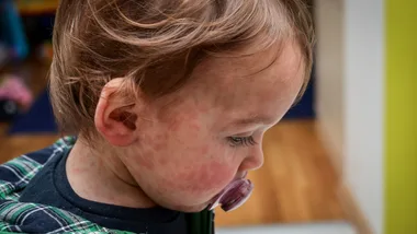 Child with measles