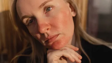 skincare for rosacea