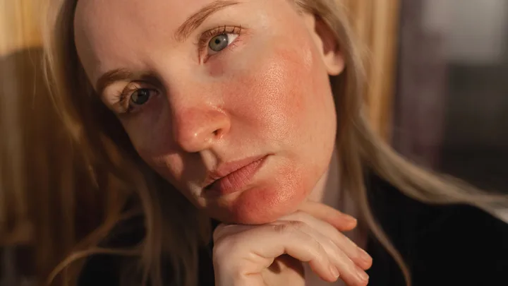 skincare for rosacea
