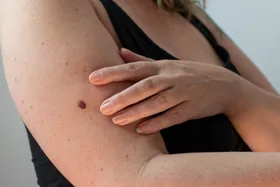 World-first vaccine delivers major skin cancer breakthrough