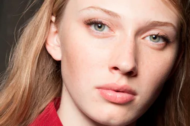 The Internet Is Losing It Over This Woman’s Before-And-After Acne Photos