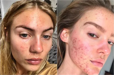 Elyse Knowles And Georgia Gibbs Get Brutally Honest About Their Acne Battles