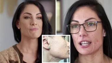 MAFS’ Vanessa Romito says she was bullied because of her acne