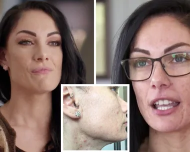 MAFS’ Vanessa Romito says she was bullied because of her acne