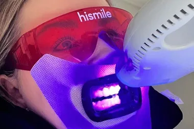 Person undergoing teeth whitening with UV light, wearing protective red glasses labeled "hismile."