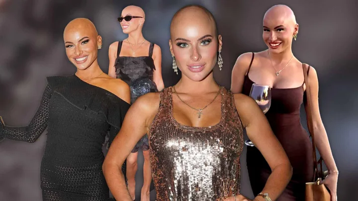 Alopecia Advocate Chloe Bean On Going Bald, For A Third Time