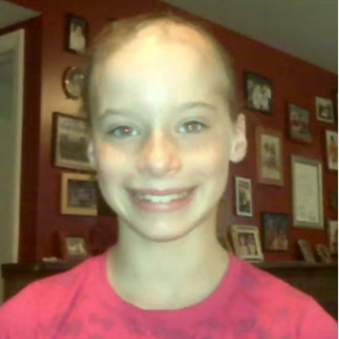 chloe-bean-alopecia